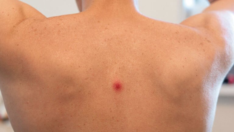 Qué significa ser un nacido en la piel y cuáles son sus características